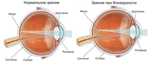 КАК УЛУЧШИТЬ ЗРЕНИЕ 