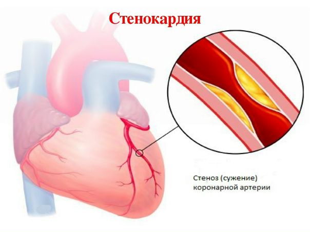 Ишемическая болезнь сердца — это группа заболеваний, которые характеризуются нарушением кровообращения в артериях, призванных обеспечивать сердечную мышцу (миокард) необходимым запасом крови. Из-за того, что эти артерии называются коронарными, то и ишемия (недостаточное кровоснабжение органа) получила название 