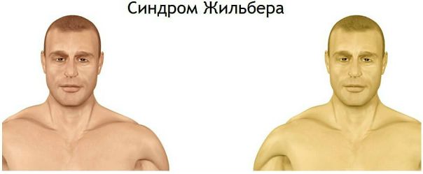 Синдром Жильбера – генетически обусловленное нарушение обмена билирубина, возникающее вследствие дефекта микросомальных ферментов печени и приводящее к развитию доброкачественной неконьюгированной гипербилирубинемии. В большинстве случаев синдрома Жильбера отмечается интермиттирующая желтуха различной степени выраженности, тяжесть в правом подреберье, диспепсические и астеновегетативные расстройства; возможно появление субфебрилитета, гепатомегалии, ксантелазм век. Диагноз синдрома Жильбера подтверждают данные клинической картины, семейного анамнеза, лабораторных и инструментальных исследований, функциональных проб. При синдроме Жильбера показано соблюдение режима питания, прием индукторов микросомальных ферментов, гепатопротекторов, желчегонных трав, энтеросорбентов, витаминов. 