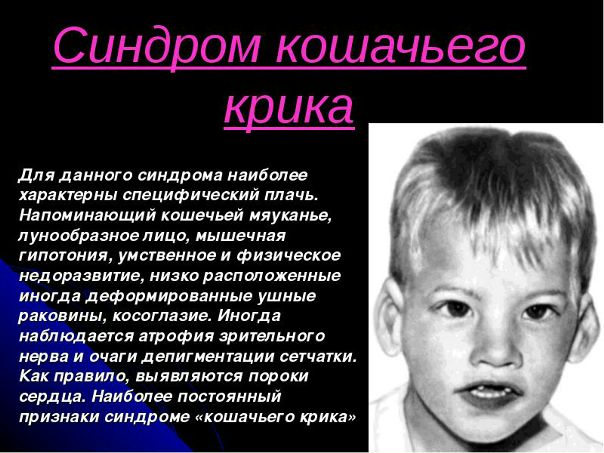 Синдром кошачьего крика 