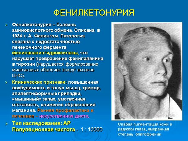 Фенилкетонурия 