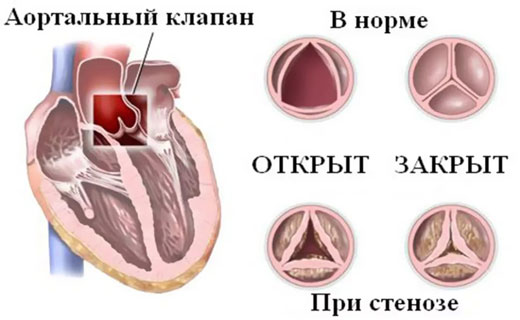 Стеноз устья аорты 