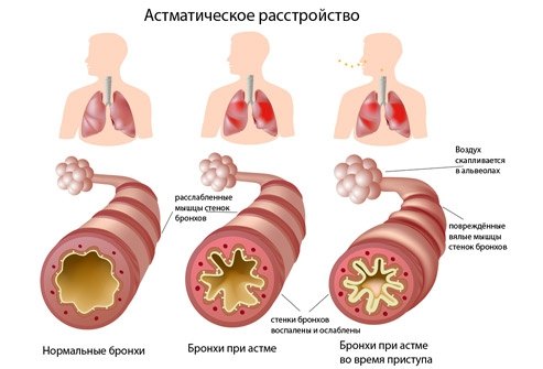 Астматический статус- критическое состояние у больных хроническими обструктивными заболеваниями легких, проявляющееся прогрессирующей острой комбинированной дыхательной недостаточностью тяжелой степени, сердечно-сосудистой недостаточностью и синдромом эндогенной интоксикации при полной неэффективности помогавших ранее бронхолитиков (симпатомиметиков). 