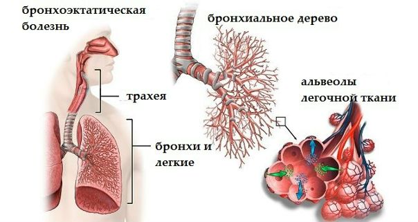 Бронхоэктатическая болезнь характеризуется регионарным расширением бронхов с преимущественной локализацией процесса в нижних отделах легких, проявляется симптомами гнойного бронхита, нередко кровохарканьем. 