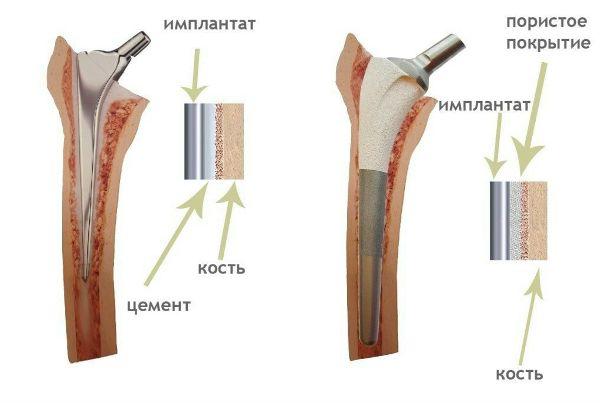 Уникальная замена настоящим костям была опробована на животном