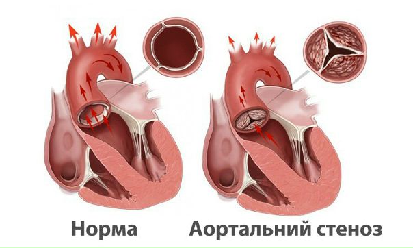 Аортальный стеноз 