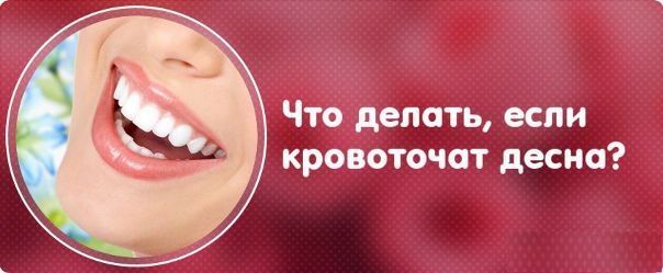 ЕСЛИ КРОВОТОЧАТ ДЕСНА 