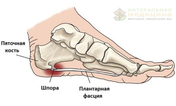 ПЯTОЧНАЯ ШПОРА И КОСTОЧКИ: 17 ЭФФЕКTИВНЫХ РЕЦЕПTОВ НАРОДНОЙ МЕДИЦИНЫ 
